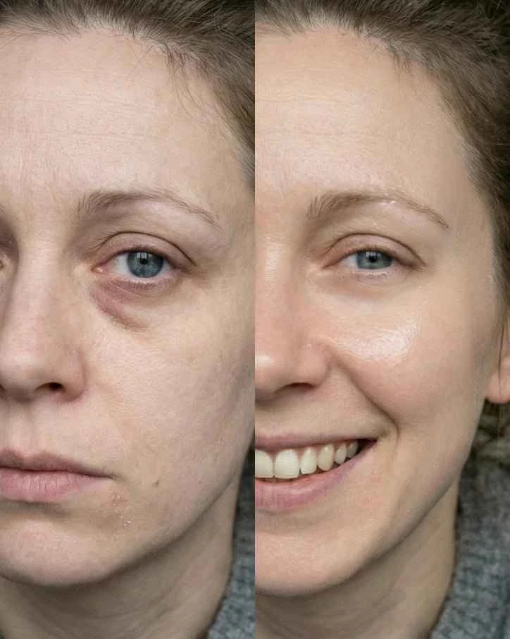 WAVLO Apollo SG LED light therapy Before and After use results
